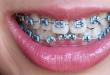 Ретейнеры для зубов после брекетов: зачем нужны, как устанавливаются и насколько