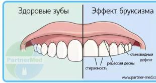 Բրուքսիզմ կամ ատամների կրճտում