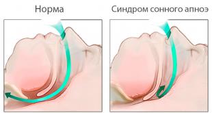 Քնի apnea-ի պատճառները. ախտորոշում և բուժում մեծահասակների մոտ
