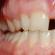 Why does a child’s teeth grow second row: how to correct defects If teeth grow second row